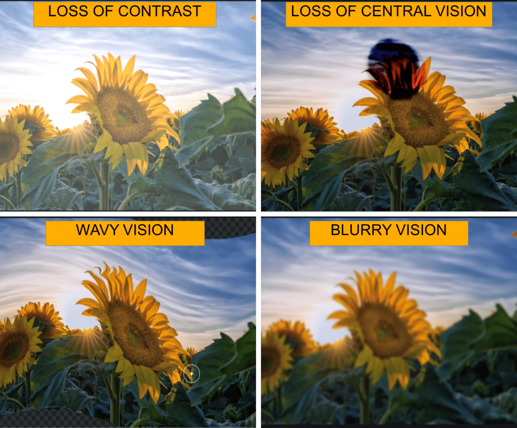 symptoms of Age Related Macular Degeneration