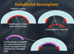 Endothelial Keratoplasty (EK)