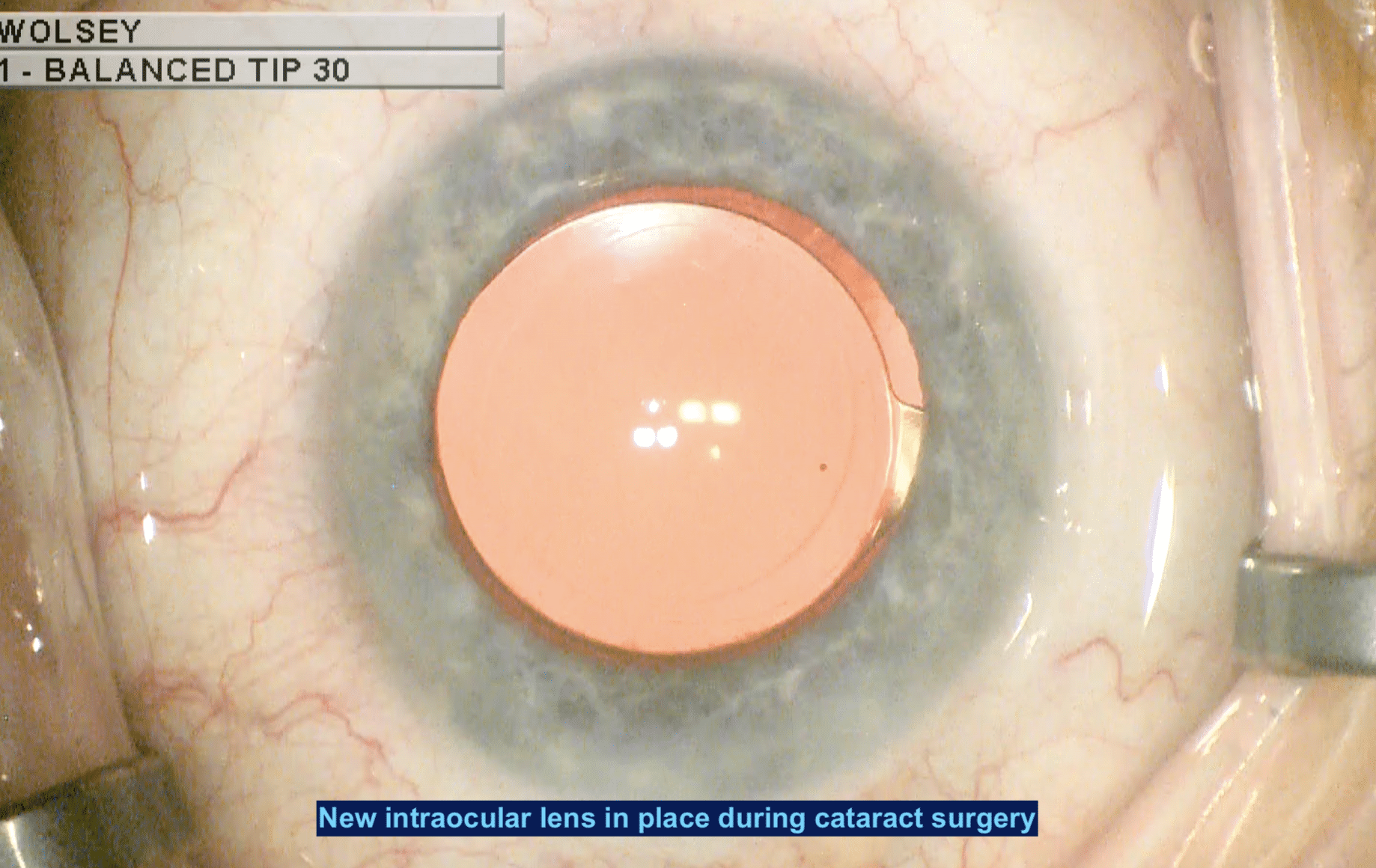 Cataract