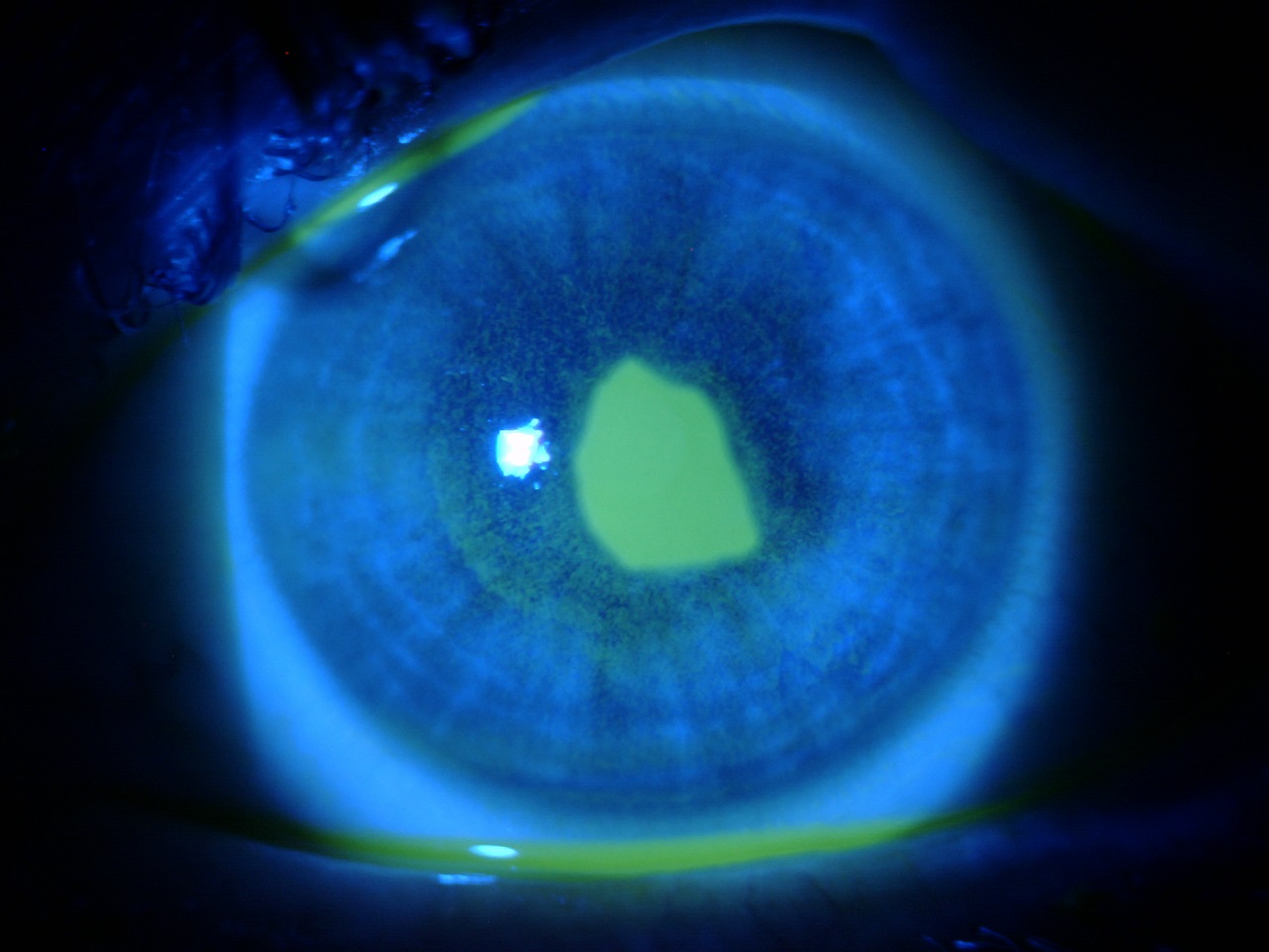 Corneal Abrasion