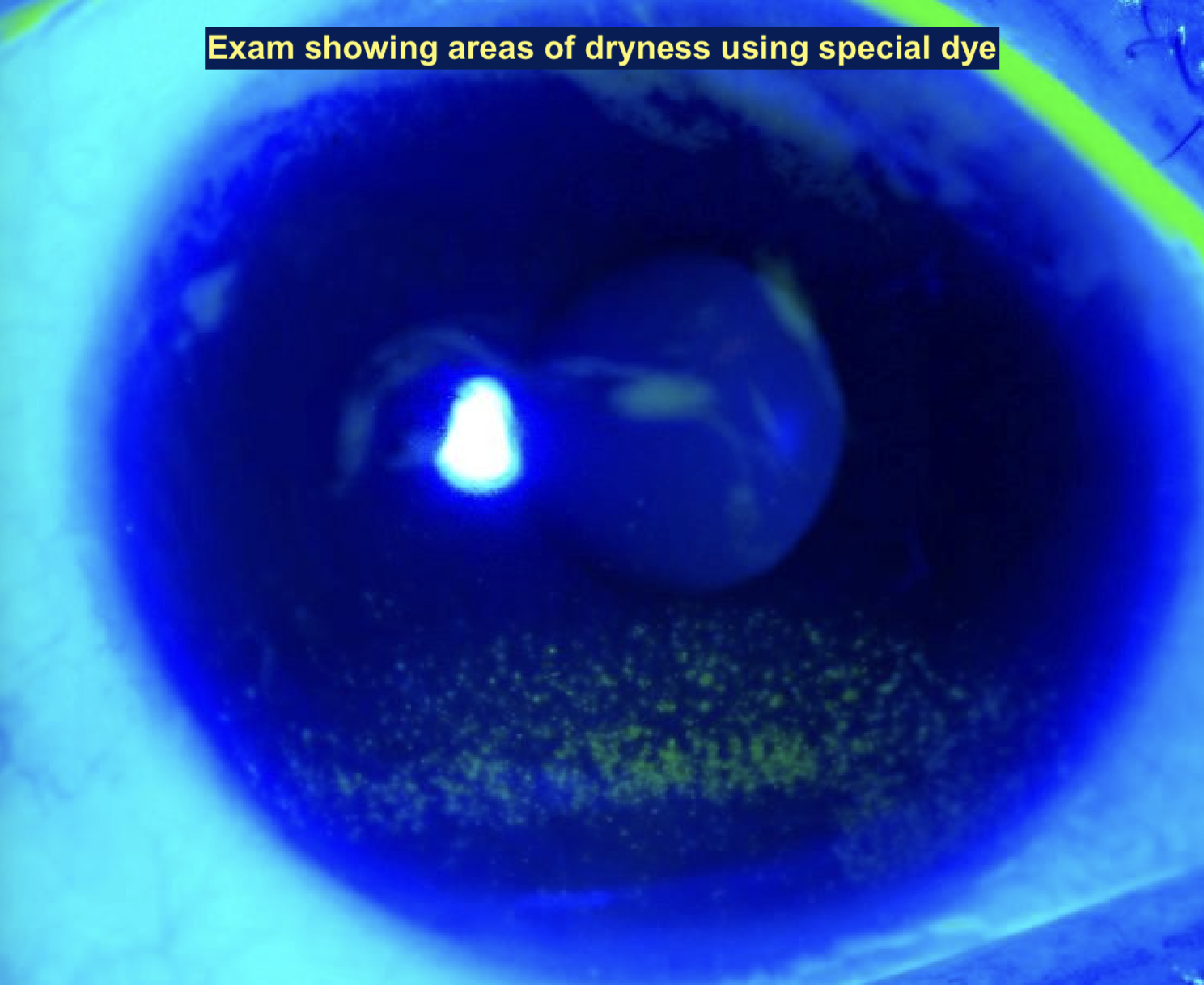 Dry Eye 1