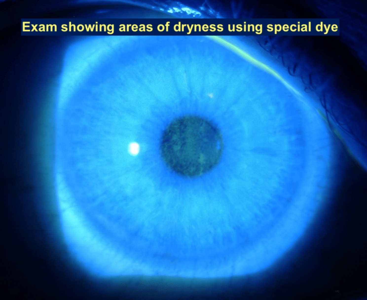 Dry Eye 2