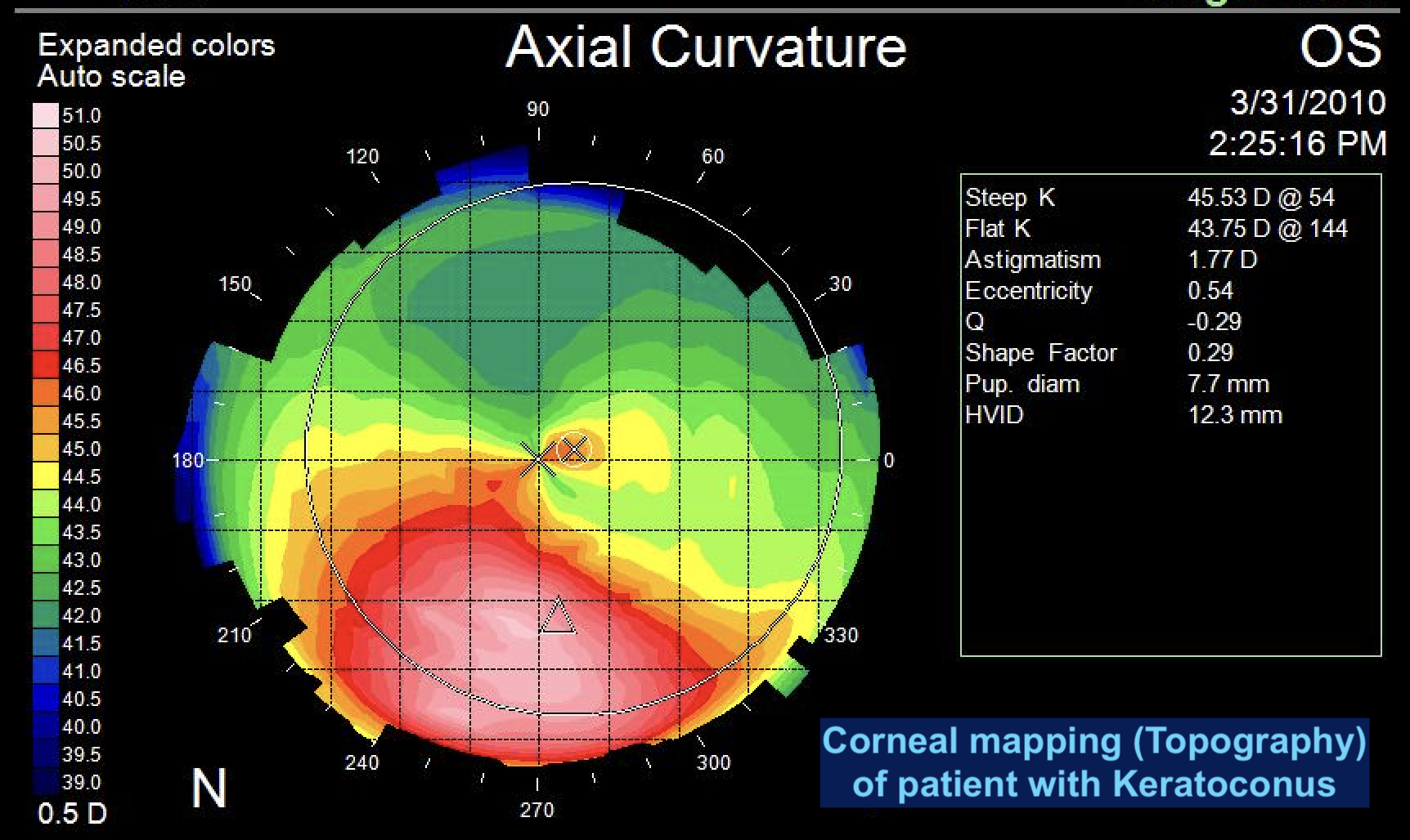 Keratoconus 1 Keratoconus 1