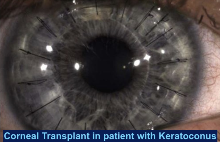 Keratoconus 2